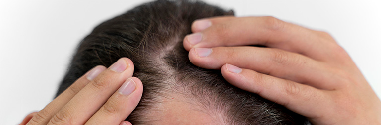 آیا بیوتین به جلوگیری از ریزش مو کمک میکند