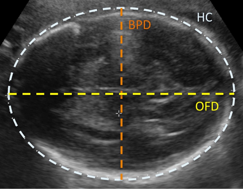 bpd در سونوگرافی جنین چیست