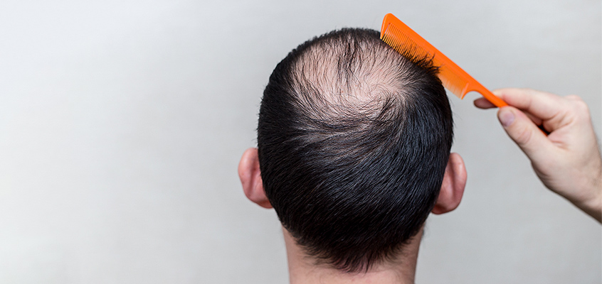 درمان ریزش مو در مردان