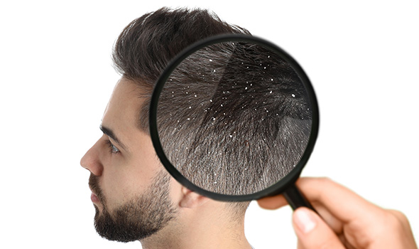 مراقبت از مو در برابر شوره سر