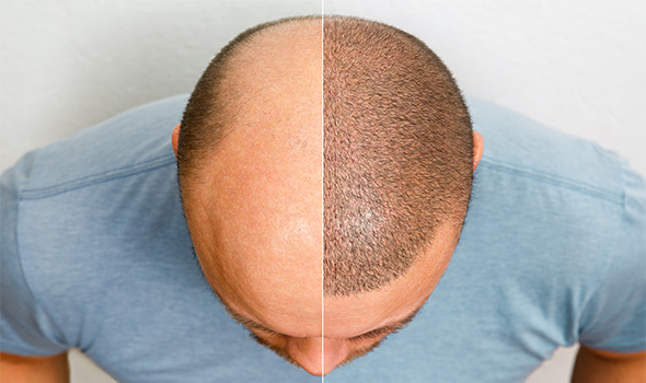 کاشت مو به روش sut چیست؟
