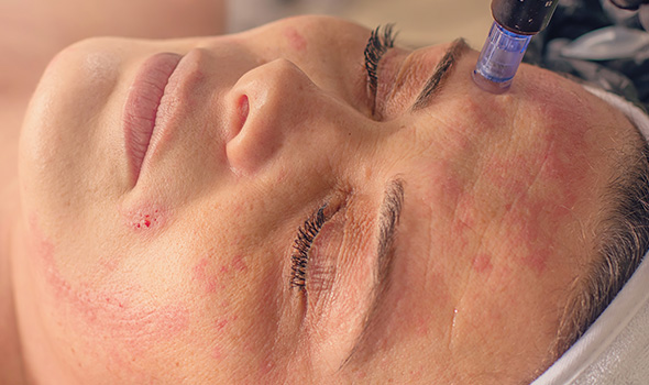 عوارض جانبی درمان منافذ باز پوست با میکرونیدلینگ