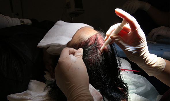 عوارض کاشت مو برای زنان
