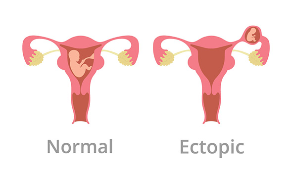بارداری خارج از رحم چیست؟
