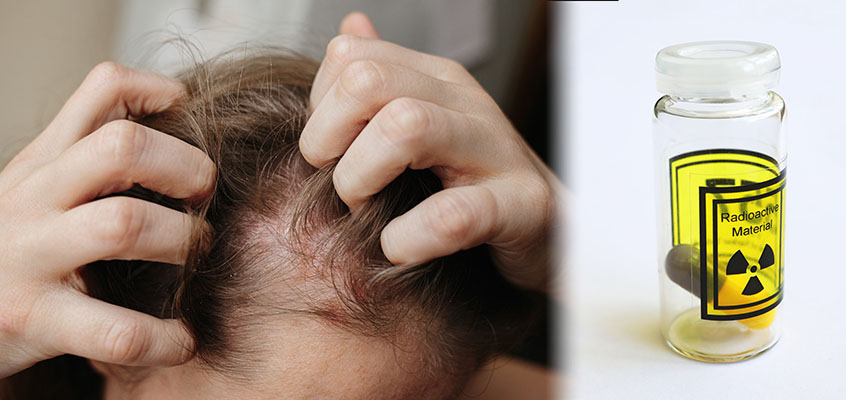 آیا ید درمانی باعث ریزش مو می شود؟