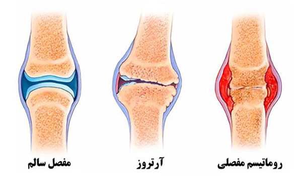 تفاوت آرتروز با روماتیسم مفصلی-01