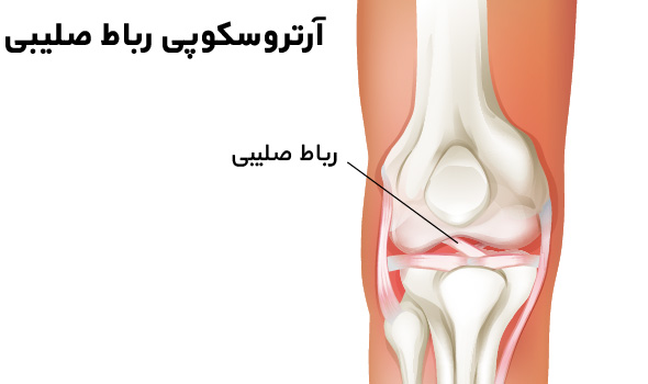 آرتروسکوپی رباط صلیبی