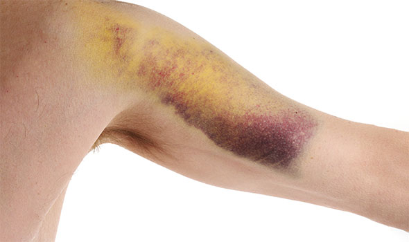 عوارض آرتروسکوپی شانه