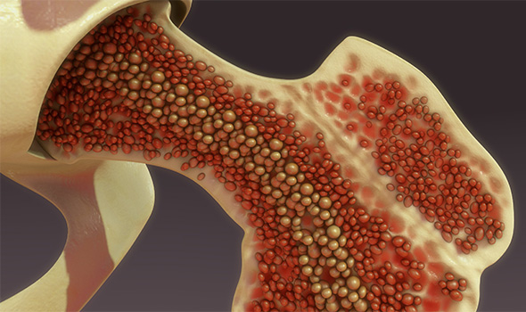 مراحل درمان آرتروز زانو با سلول‌های بنیادی