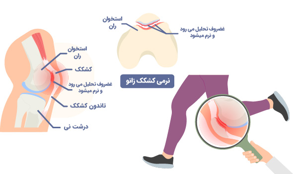 کندرومالاسی چیست؟