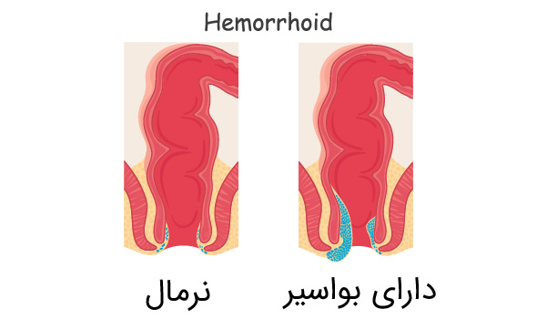 بیرون زدگی بواسیر در بارداری