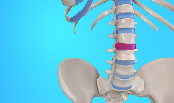 فرق دیسک کمر با پارگی دیسک کمر