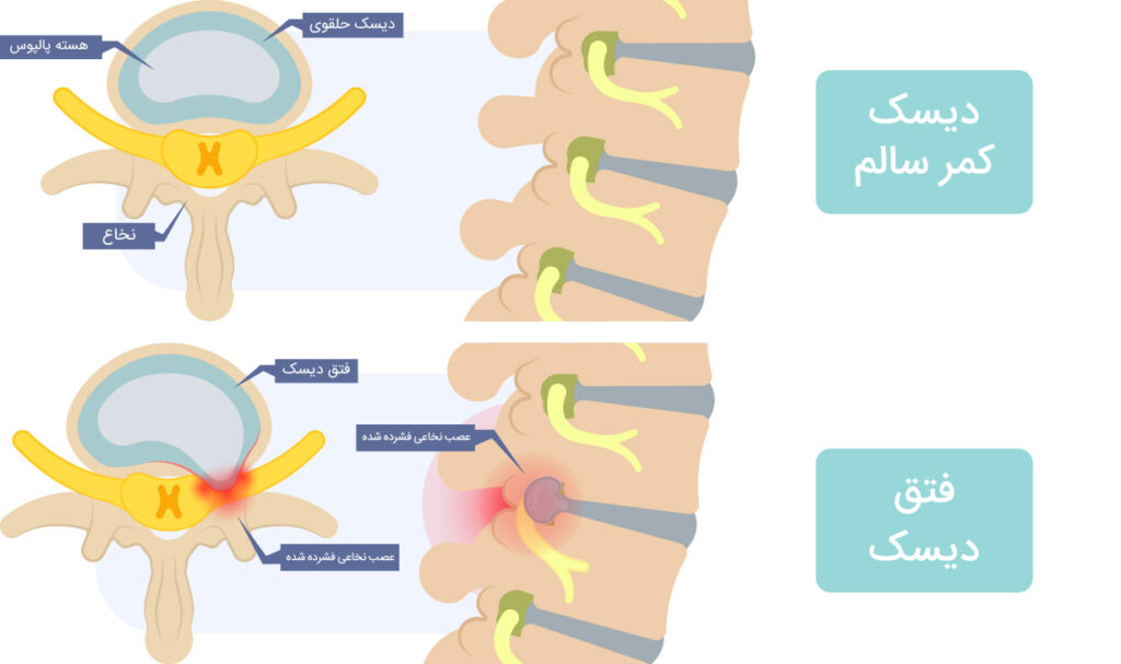 پارگی دیسک کمر چیست؟-01