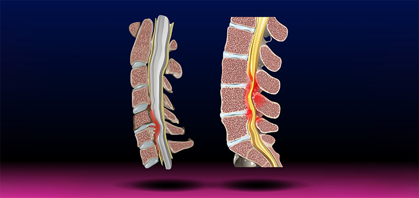 تنگی کانال نخاعی(کمر)
