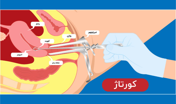 دستگاه کورتاژ چه شکلیه؟