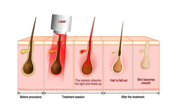 لیزر موهای زائد چگونه انجام می شود؟