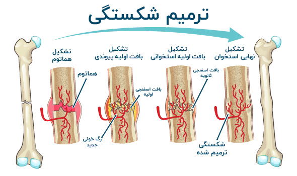 نشانه های جوش خوردن استخوان